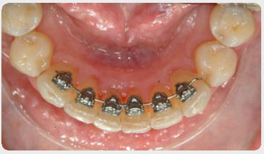 aparat dentar social six